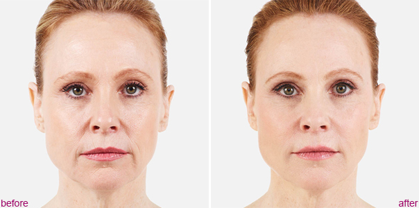 Juvederm Voluma Before and After