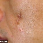 fraxel-scar-removal-before
