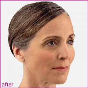 Voluma Before After (after)